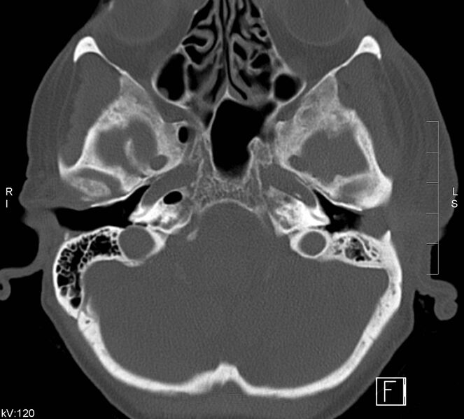 File:Necrotizing otitis externa (Radiopaedia 19938-19971 Axial bone window 3).jpg