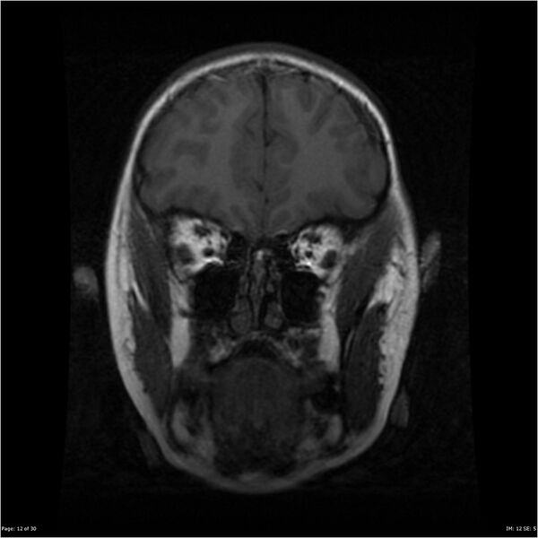 File:Neurofibromatosis type 1 (Radiopaedia 22541-22564 Coronal T1 21).jpg