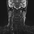 Neurofibromatosis type 1 (Radiopaedia 80355-93740 Coronal STIR 3).jpg