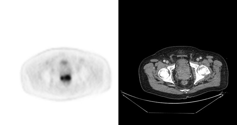 File:Non-Hodgkin lymphoma involving seminal vesicles with development of interstitial pneumonitis during Rituximab therapy (Radiopaedia 32703-33675 axial PET CT 8).jpg