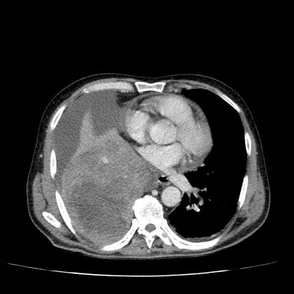File:Non small-cell lung cancer (Radiopaedia 24467-24769 C+ delayed 37).jpg
