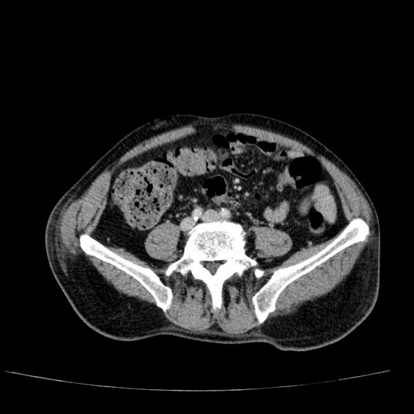 File:Non small-cell lung cancer (Radiopaedia 24467-24769 C+ delayed 91).jpg