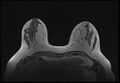 Normal breast MRI - dense breasts (Radiopaedia 80454-93850 Axial T1 75).jpg