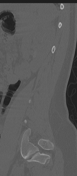 File:Normal lumbosacral CT (Radiopaedia 37923-39867 Sagittal bone window 19).png