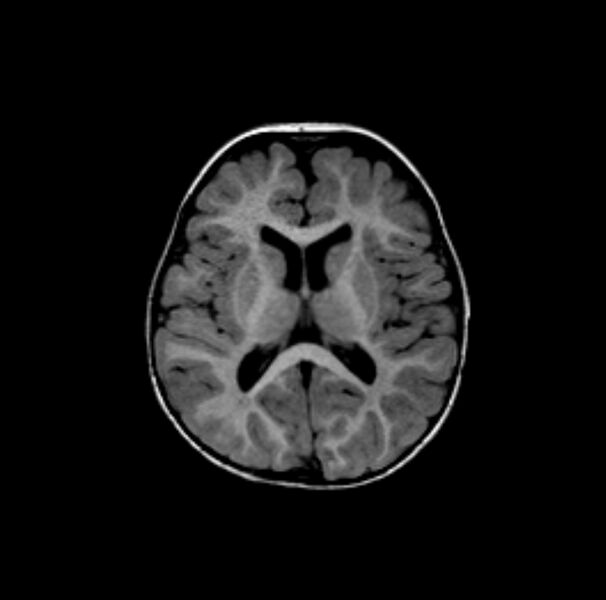 File:Normal myelination 19 month old (Radiopaedia 6813-7981 Axial T1 2).jpg