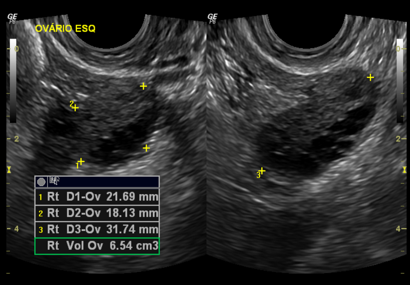 File:Normal pelvic ultrasound - transvaginal (Radiopaedia 31750-32684 H 1).png