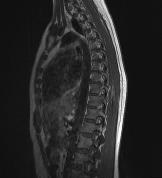 File:Normal thoracic spine MRI (Radiopaedia 41033-43781 Sagittal T1 10).jpg