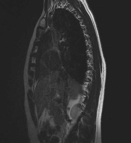 File:Normal thoracic spine MRI (Radiopaedia 41033-43781 Sagittal T2 1).jpg