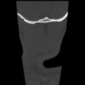Normal trauma cervical spine (Radiopaedia 41017-43760 Coronal bone window 53).png