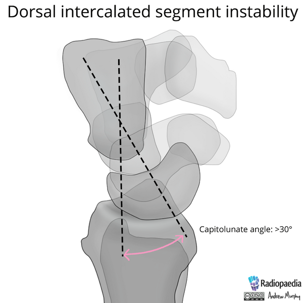 File:Normal wrist alignment, dorsal and volar intercalated segmental instability (illustration) (Radiopaedia 80949-94486 A 7).png