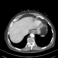 Nutmeg liver (Radiopaedia 49958-55246 A 9).png