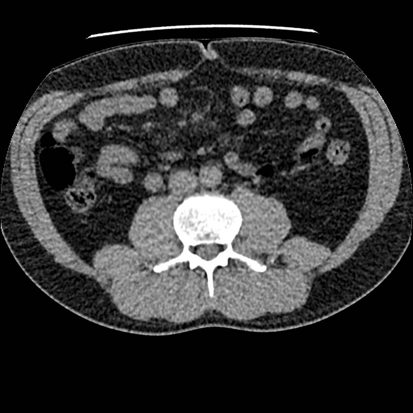 Obstructing ureteric calculus and ureteric anatomy (Radiopaedia 62730-71042 Axial non-contrast 69).jpg