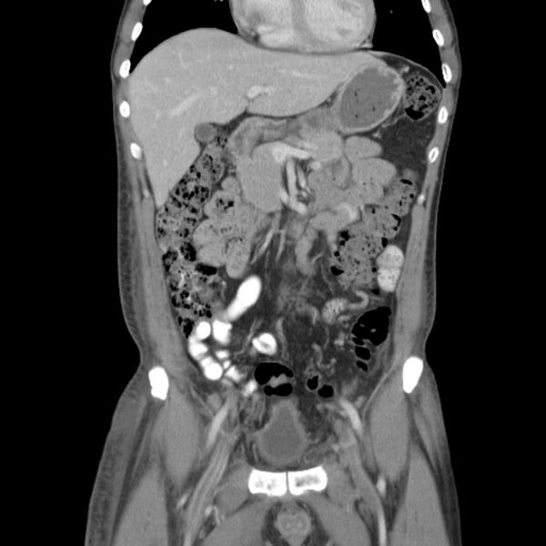 File:Obstructive bladder transitional cell carcinoma (Radiopaedia 9825-10410 B 5).jpg