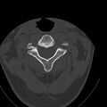 Occipital condyle fracture (Radiopaedia 31755-32691 Axial bone window 24).jpg