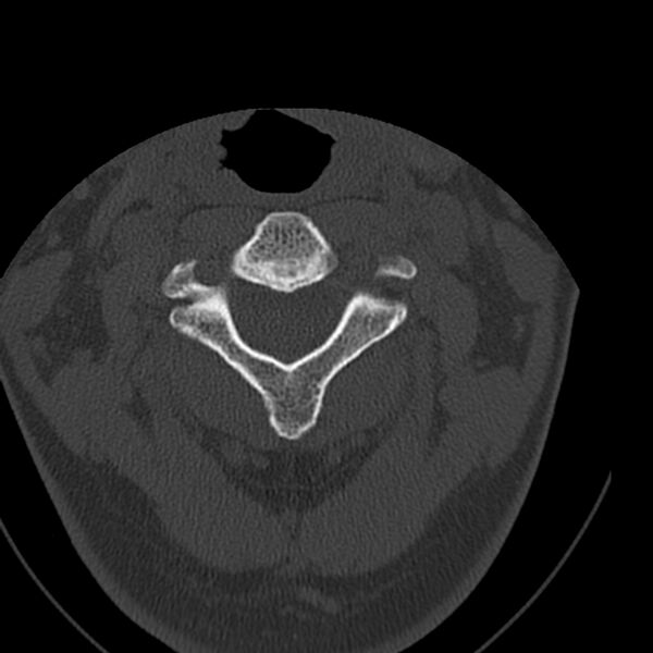 File:Occipital condyle fracture (Radiopaedia 31755-32691 Axial bone window 24).jpg