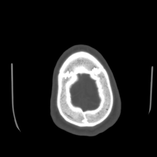 File:Occipital spur - asymptomatic (Radiopaedia 87753-104201 Axial bone window 200).jpg