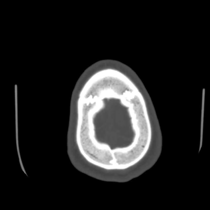 Occipital spur - asymptomatic (Radiopaedia 87753-104201 Axial bone window 200).jpg