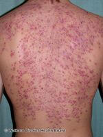 Severe acne on back