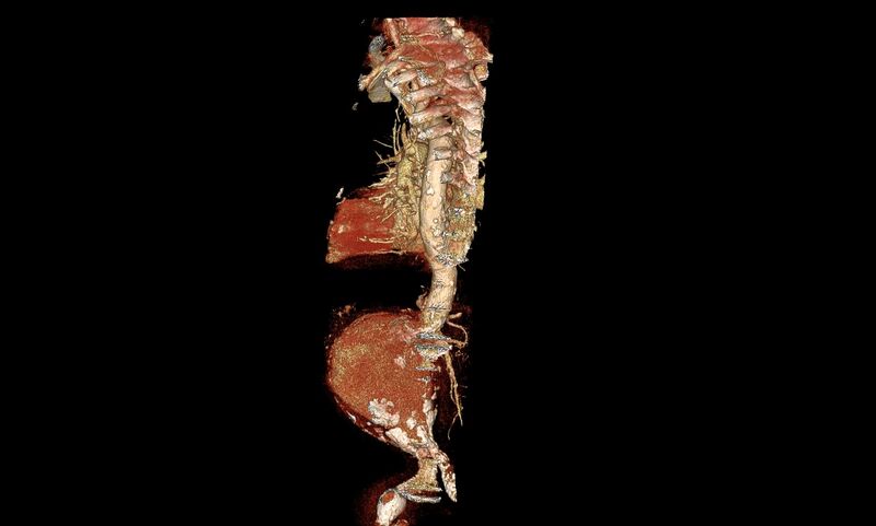 File:Abdominal aortic aneurysm- extremely large, ruptured (Radiopaedia 19882-19921 3D 12).jpg