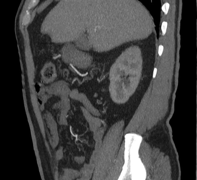 File:Abdominal aortic aneurysm (Radiopaedia 22421-22458 D 5).jpg