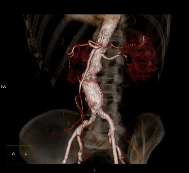File:Abdominal aortic aneurysm (Radiopaedia 23703-23856 3D 24).jpg