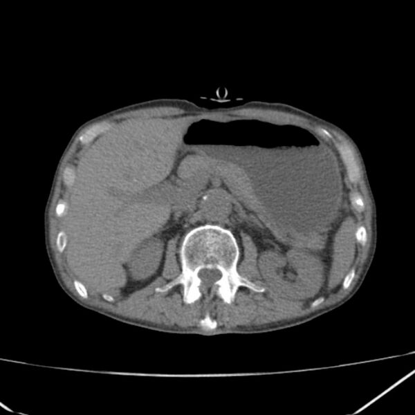 File:Abdominal aortic aneurysm (Radiopaedia 23703-23856 Axial non-contrast 17).jpg