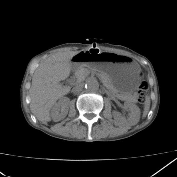 File:Abdominal aortic aneurysm (Radiopaedia 23703-23856 Axial non-contrast 19).jpg