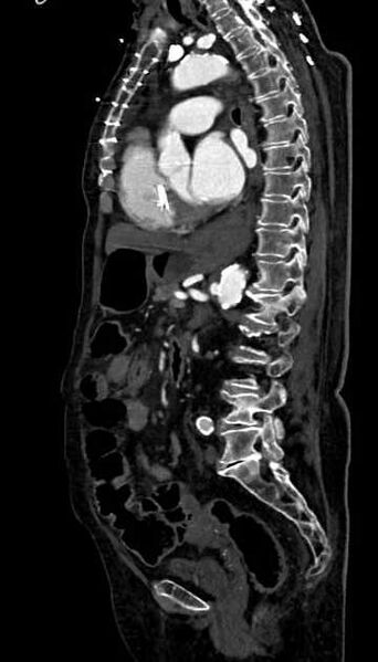File:Abdominal aortic aneurysm with thrombus fissuration (Radiopaedia 73192-83919 Sagittal C+ arterial phase 60).jpg