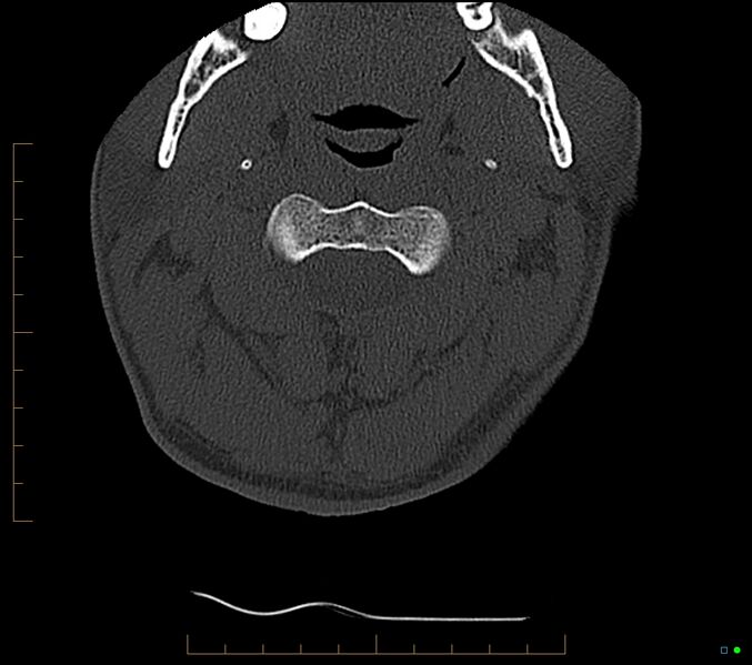 File:Accessory articulation of cervical transverse processes (Radiopaedia 82715-96933 Axial non-contrast 29).jpg