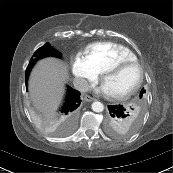 File:Acute-on-chronic pulmonary emboli (Radiopaedia 27925-28169 C+ CTPA 59).jpg