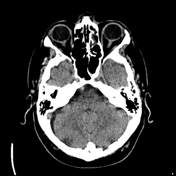 File:Acute A3 occlusion with ACA ischemic penumbra (CT perfusion) (Radiopaedia 72036-82525 Axial non-contrast 10).jpg