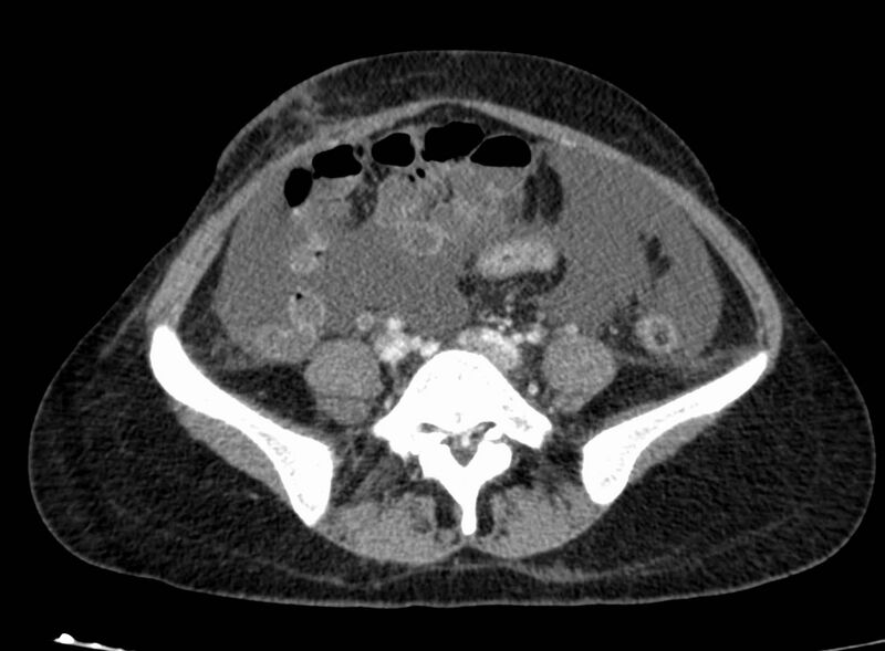 File:Acute Budd-Chiari syndrome (Radiopaedia 60858-68638 Axial C+ portal venous phase 209).jpg
