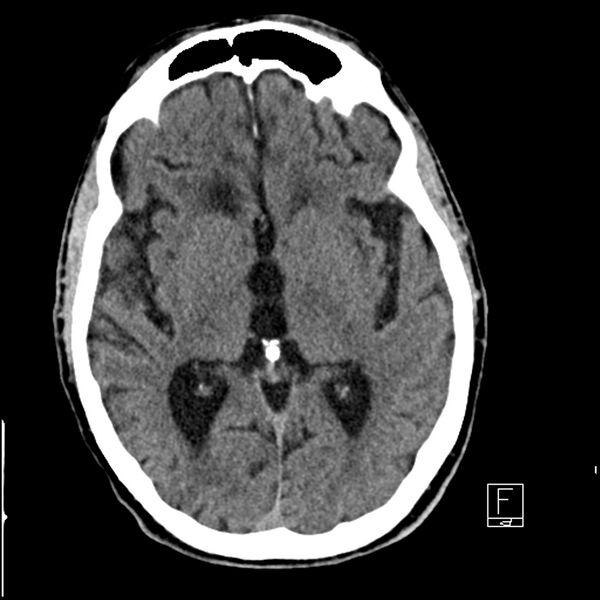 File:Acute ICA ischemic penumbra due to high-grade CCA stenosis (CT perfusion) (Radiopaedia 72038-82529 Axial non-contrast 23).jpg