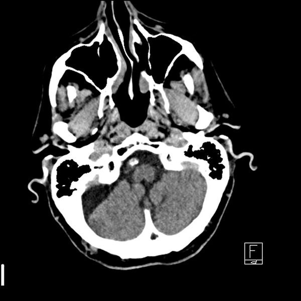 File:Acute ICA ischemic penumbra due to high-grade CCA stenosis (CT perfusion) (Radiopaedia 72038-82529 Axial non-contrast 5).jpg