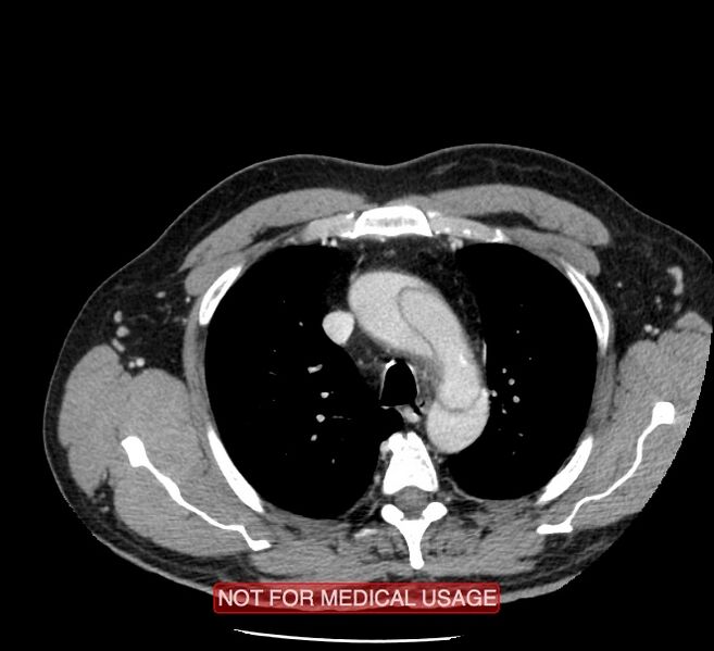 File:Acute aortic dissection - Stanford type A (Radiopaedia 40661-43285 Axial C+ portal venous phase 5).jpg