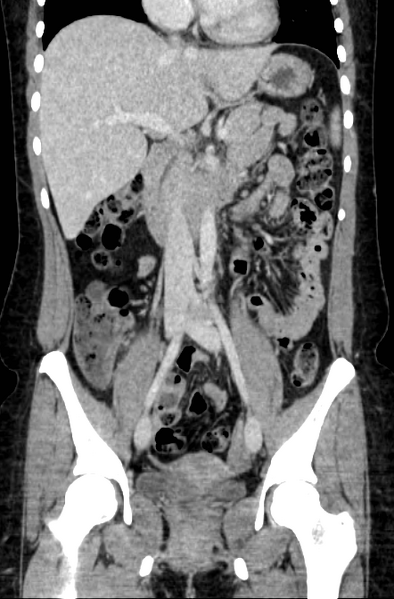 File:Acute appendicitis (Radiopaedia 22892-22918 Coronal C+ portal venous phase 24).png