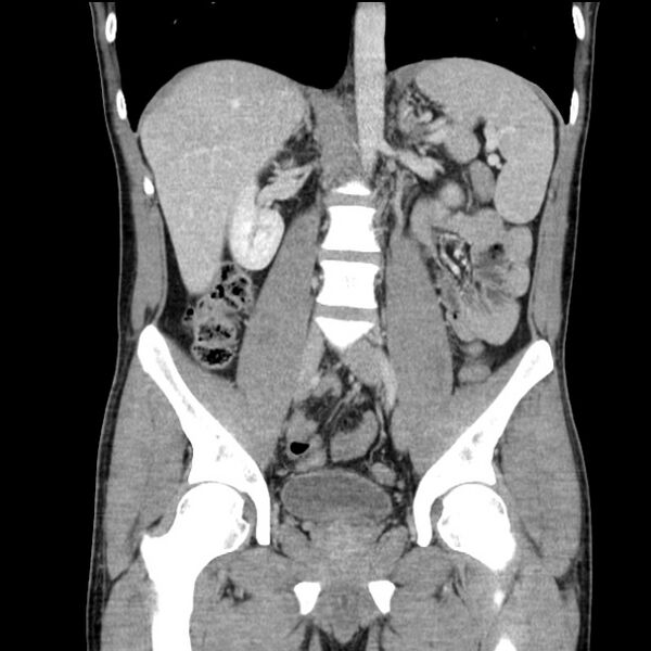 File:Acute appendicitis (Radiopaedia 27049-27227 Coronal C+ portal venous phase 31).jpg