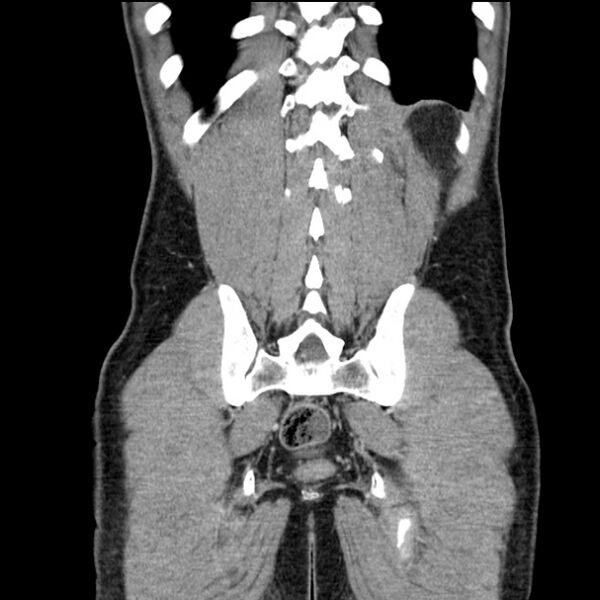 File:Acute appendicitis (Radiopaedia 27049-27227 Coronal C+ portal venous phase 48).jpg