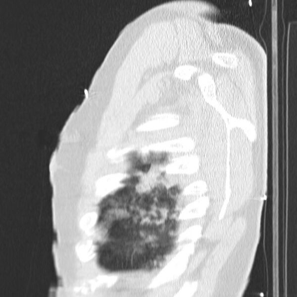 File:Acute aspiration pneumonitis (Radiopaedia 33605-34703 Sagittal lung window 78).jpg