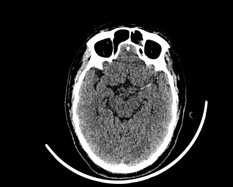 File:Acute cerebral infarct (Radiopaedia 35604-37123 Axial non-contrast 41).jpg