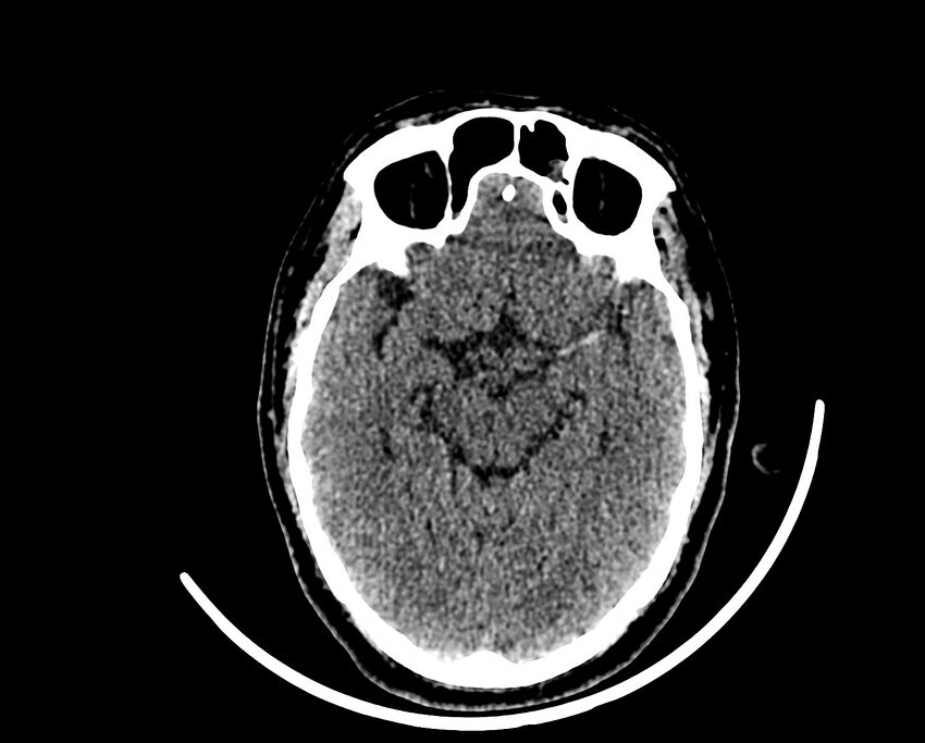 Acute cerebral infarct (Radiopaedia 35604-37123 Axial non-contrast 41).jpg