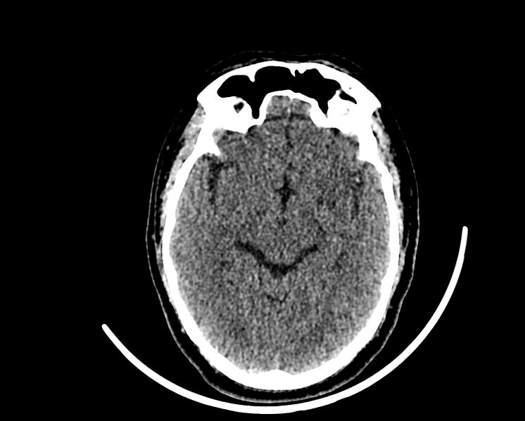 File:Acute cerebral infarct (Radiopaedia 35604-37123 Axial non-contrast 43).jpg