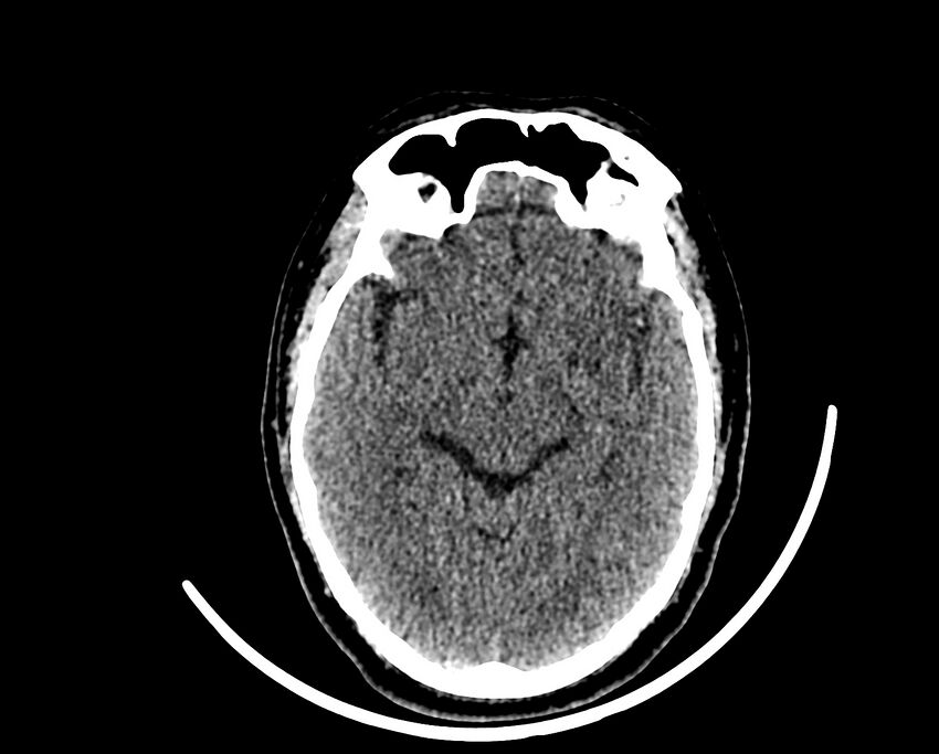 Acute cerebral infarct (Radiopaedia 35604-37123 Axial non-contrast 43).jpg