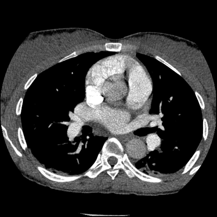 Acute chest syndrome - sickle cell disease (Radiopaedia 42375-45499 Axial C+ CTPA 89).jpg