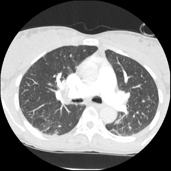 File:Acute chest syndrome - sickle cell disease (Radiopaedia 42375-45499 Axial lung window 77).jpg