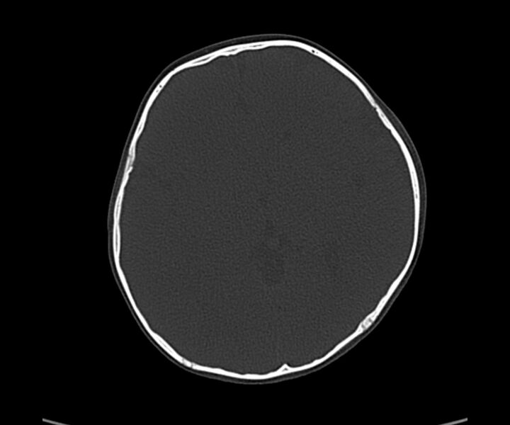 File:Acute hemorrhagic contusion (Radiopaedia 63660-72336 Axial bone window 34).jpg