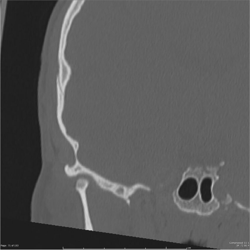 Acute otomastoiditis (Radiopaedia 28276-28512 Coronal PTB bone window reformat 2).jpg