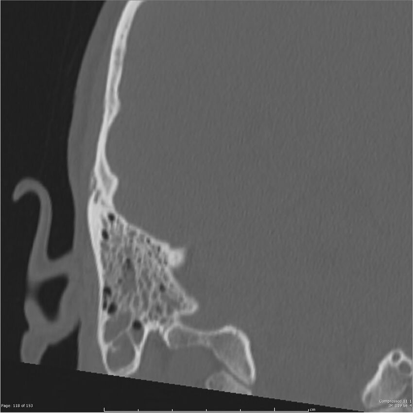 Acute otomastoiditis (Radiopaedia 28276-28512 Coronal PTB bone window reformat 49).jpg