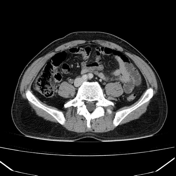 File:Acute pancreatitis (Radiopaedia 22572-22596 Axial C+ portal venous phase 48).jpg