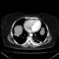 Acute pancreatitis - Balthazar C (Radiopaedia 26569-26714 Axial C+ arterial phase 4).jpg